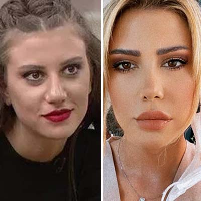 Melis Buse Betkayan son hali, estetiksiz hali